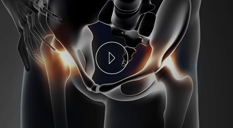 Educational Video From Benjamin Young, M.D. Orthopedic Surgeon