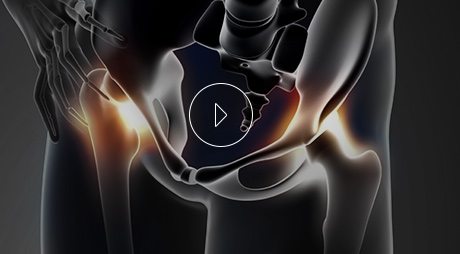 Educational Video From Benjamin Young, M.D. Orthopedic Surgeon