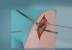 Anterior Hip Replacement