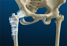 Hip Fracture Treatment