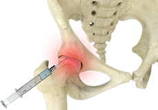 Hip Injections