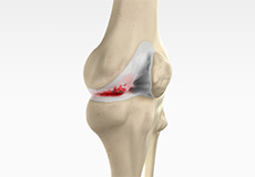 Knee Arthritis