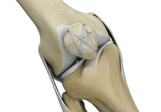 Knee Fracture Treatment