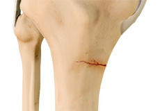 Knee Fractures