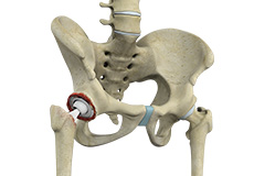 Revision Hip Replacement