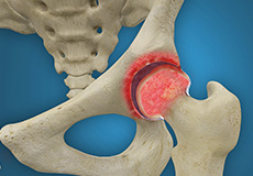 Rheumatoid Arthritis