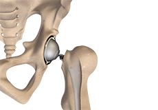 Total Hip Replacement